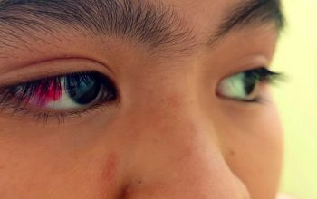 Siswa SMP Diduga Jadi Korban Bullying Berulang di Boarding School Bekasi, Orang Tua: Matanya Cedera
